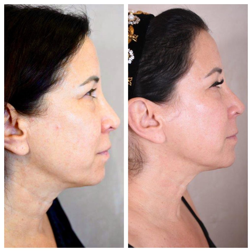 Side view of a woman, before and after having Potenza Microneedling done. 