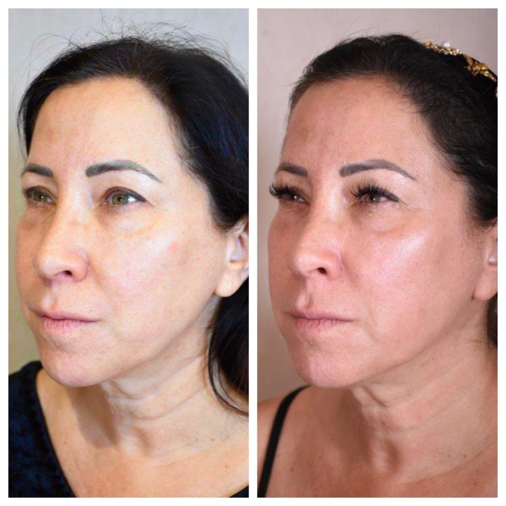 Potenza microneedling before and after pictures of a woman. 